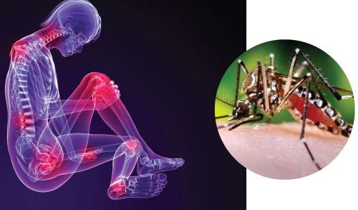 Chikungunya-2