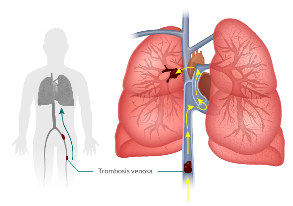 embolia_pulmonar2