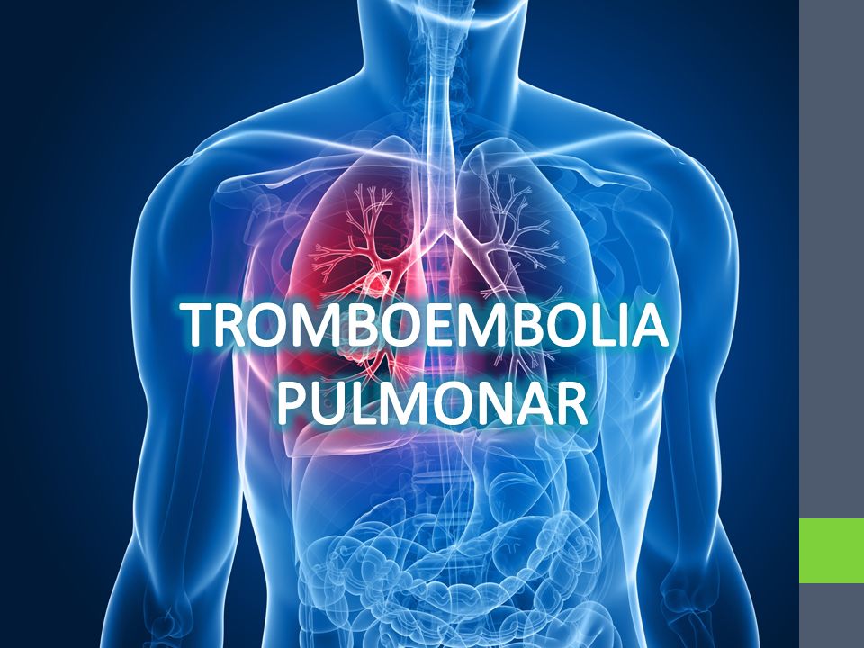 TROMBOEMBOLIA+PULMONAR